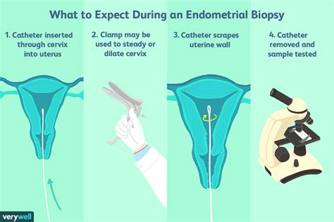 Researchers have shown that an experimental screening test can detect some endometrial and ovarian cancers at their early, more treatable stages. . Bleeding after endometrial biopsy